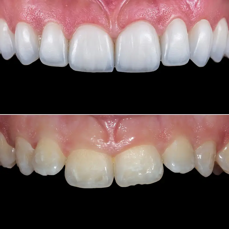 Porcelain veneers