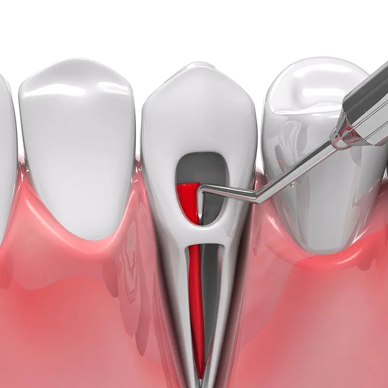 Root Canal
