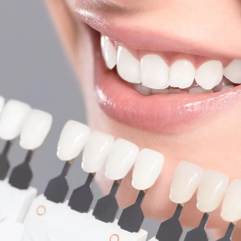 Teeth Whitening