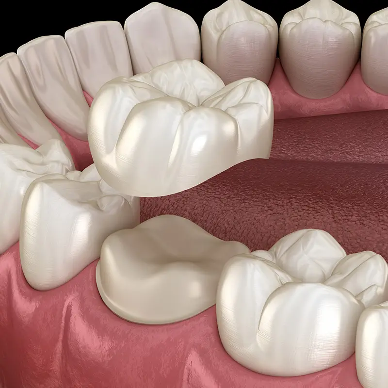 Dental Crowns