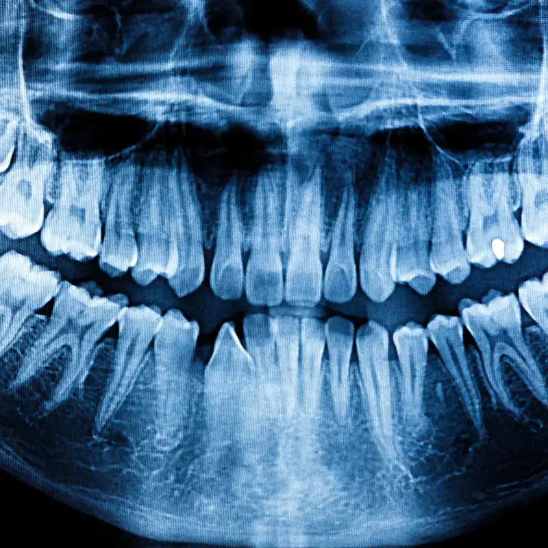 Dental X-Rays